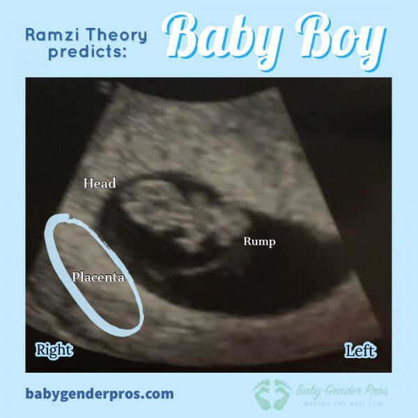 ramzi theory 9 week ultrasound