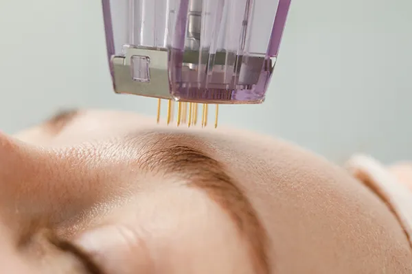 Microneedle treatment