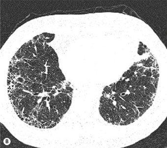 parenchymal disease of the lung | Basicmedical Key