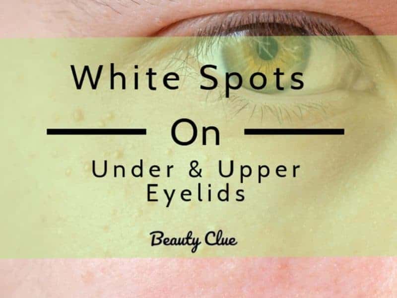 white spots under eyes