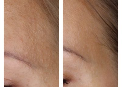 Microneedling Skin Texture Improvement after 1 treatment