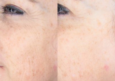 Microneedling Full Face Before & After 1 procedure