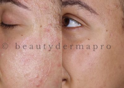 Microneedling Acne Treatment Before & After 1 procedure