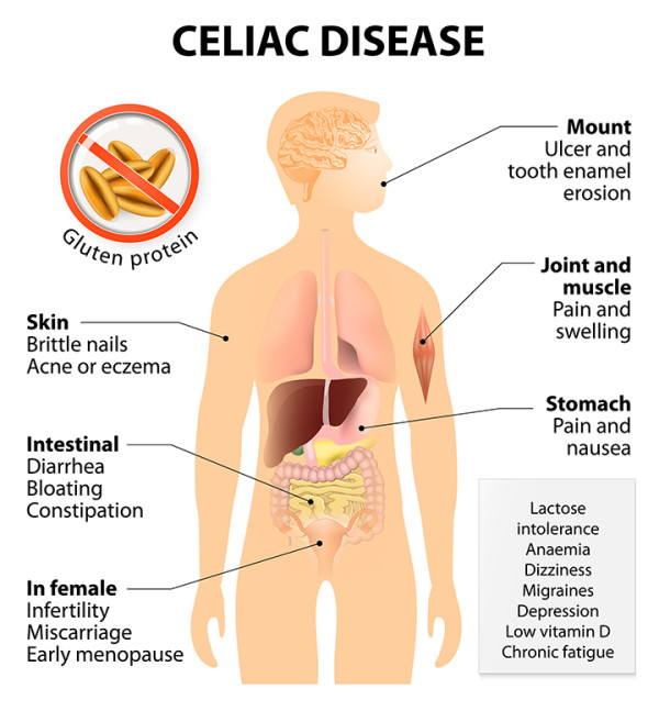 celiac symptoms, adult celiac disease symptoms