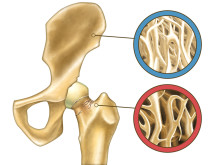 osteopenia symptoms