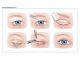 What is an eyelid correction