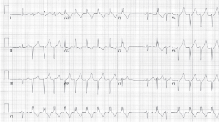 Nonsustained ventricular tachycardias - Approach | BMJ Best Practice image.