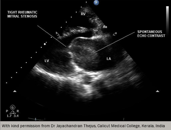 Heart valve disease module 5: medical therapies for treatment of ...