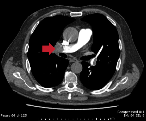 Troponin biomarkers: the benefits of echocardiography in a presumed ...