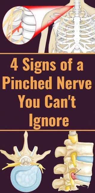 4 Crucial Signs of a Pinched Nerve You Really Should’t Ignore – Natural ...