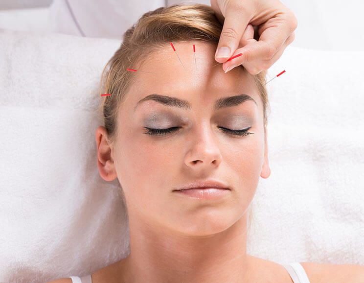 acupuncture featured image