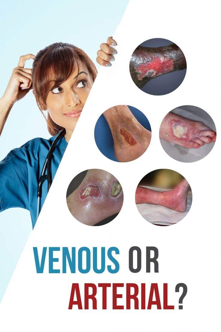 The Difference Between Venous And Arterial Ulcers Usa - vrogue.co