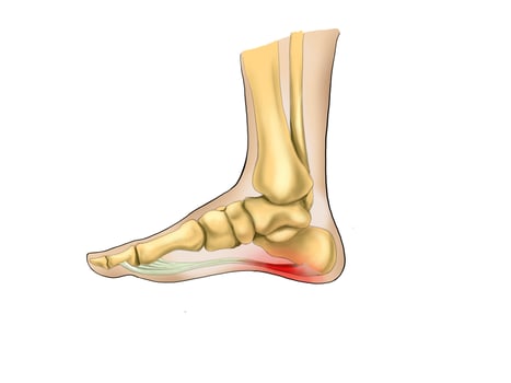 Pressure Points for Plantar Fasciitis