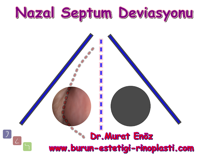 Septum deviasyonu - Burun kıkırdağı eğriliği - Nazal septum deviasyonu nasıl anlaşılır? - Deviasyon ameliyatı - Burun septumu eğriliği - Burun eğriliği