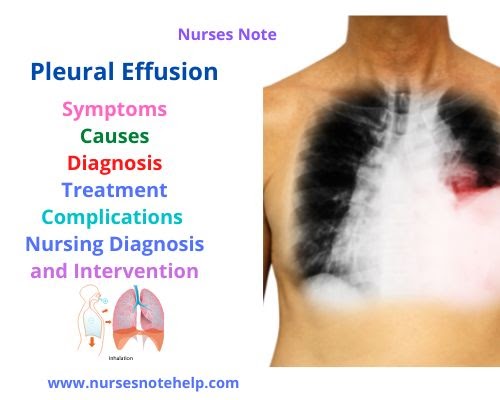 Pleural Effusion: Symptoms, Causes, Diagnosis, Treatment, Complications ...