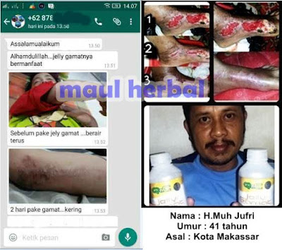 http://maulherbal.blogspot.co.id/2017/06/pengobatan-alami-untuk-infeksi-kulit.html