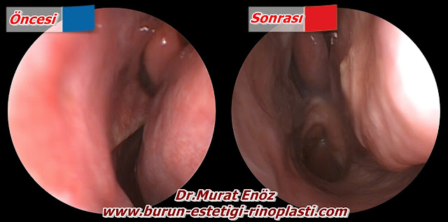 Septum deviasyonu - Burun kıkırdağı eğriliği - Nazal septum deviasyonu nasıl anlaşılır? - Deviasyon ameliyatı - Burun septumu eğriliği - Burun eğriliği