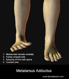   metatarsus adductus, metatarsus adductus adults, metatarsus adductus treatment shoes, metatarsus adductus stretching exercises, metatarsus adductus physical therapy, metatarsus adductus vs clubfoot, metatarsus adductus radiology, metatarsus adductus surgery, metatarsus adductus images