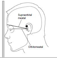 Head - CT Scan Procedure - RadTechOnDuty