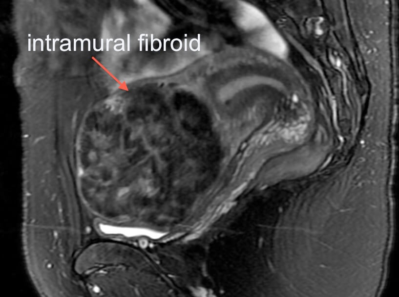 Fibroids UFE – Body MRI