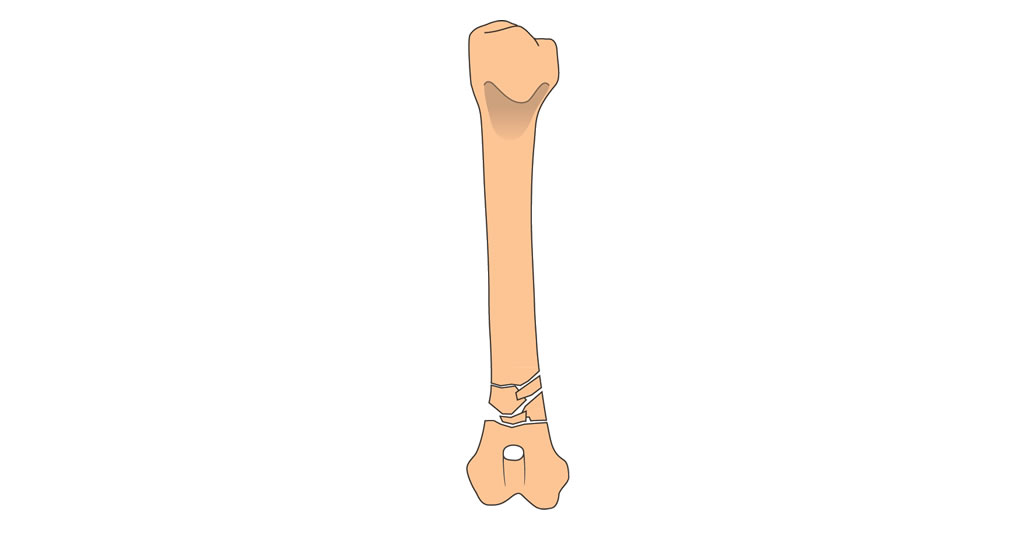 Fossum: Small Animal Fracture Fixation