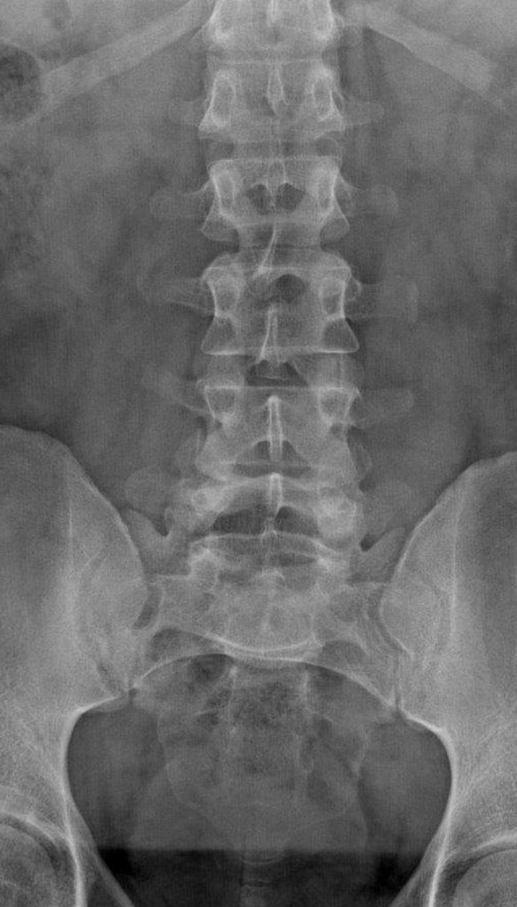 Lumbar Fracture X Ray