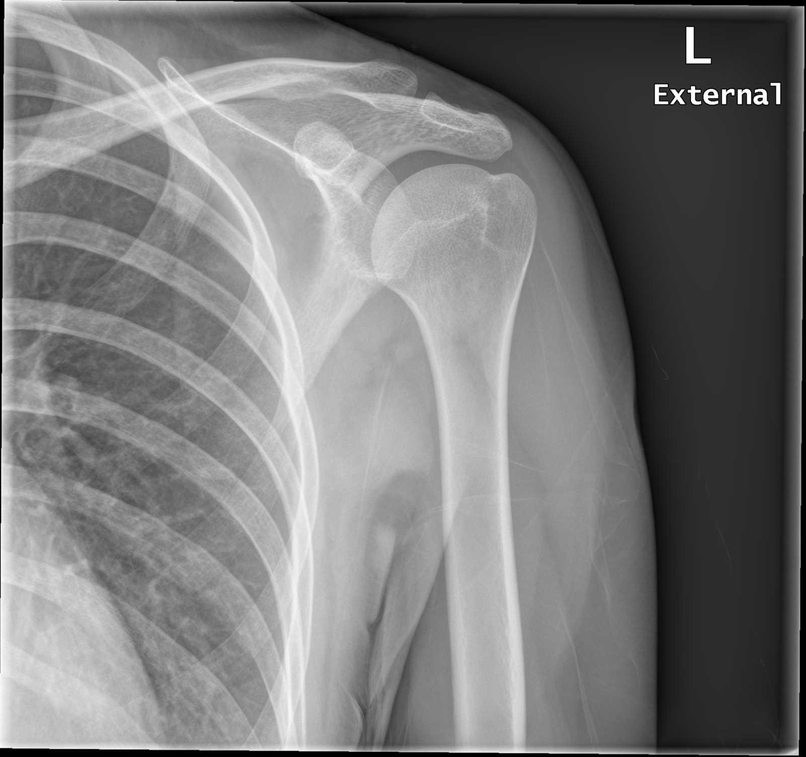 Normal Shoulder Anatomy