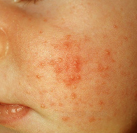 Red Bumps On Face