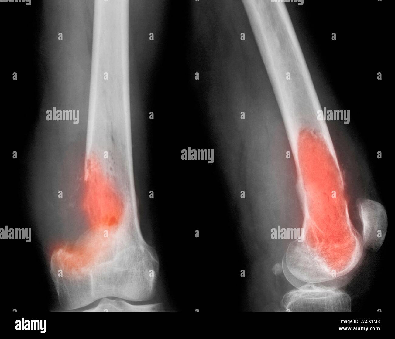 Coloured X-ray in front view (left) and side view (right) of a patient ...