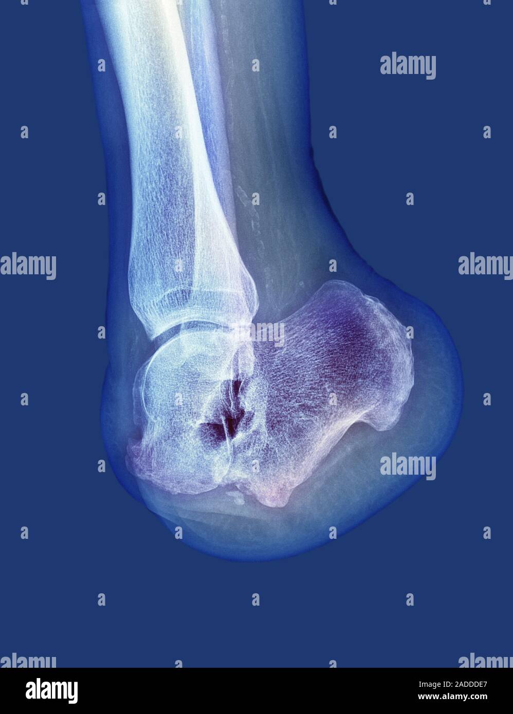 Amputated foot. Coloured X-ray of a section through the lower leg of a ...