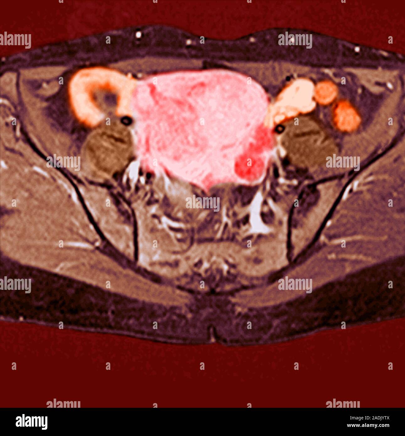 Uterine fibroid. Coloured magnetic resonance imaging (MRI) scan of a ...