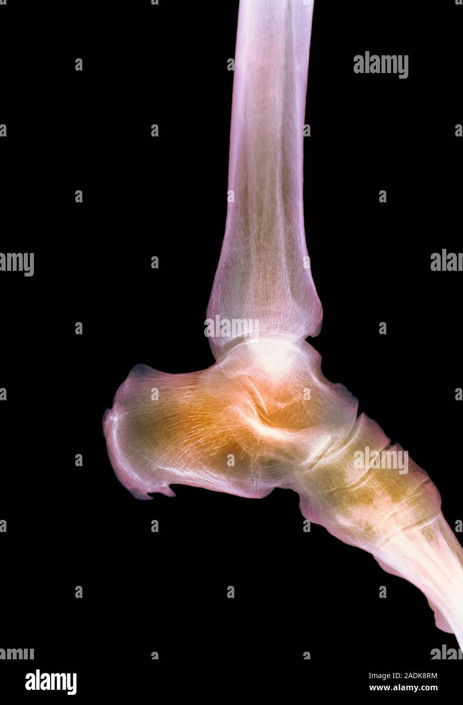 Healthy ankle. Coloured X-ray of the ankle joint of an adult woman, in ...