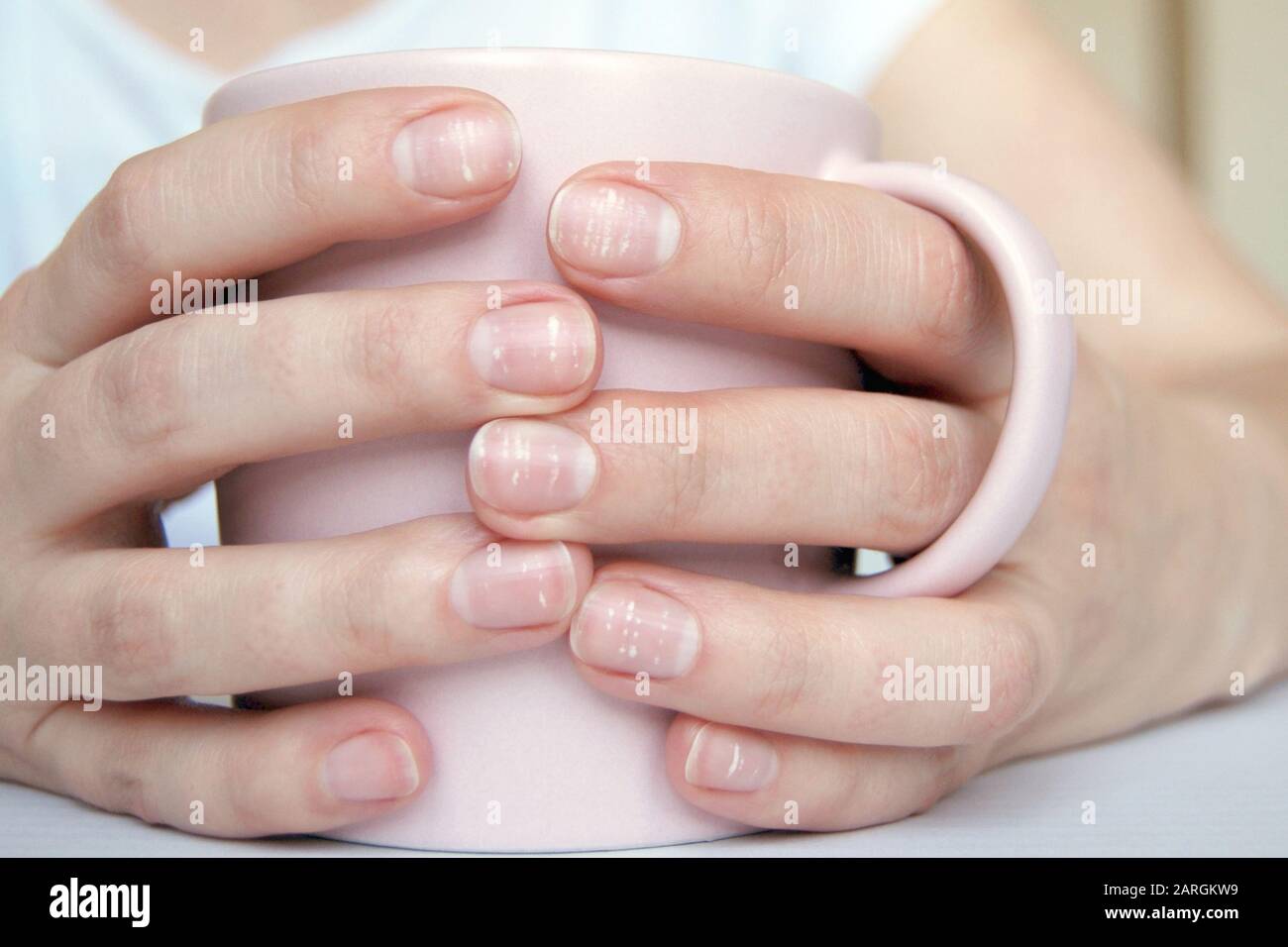 Many white spots on fingernails (Leukonychia) due to calcium deficit or stress. Female hands holding mug Stock Photo