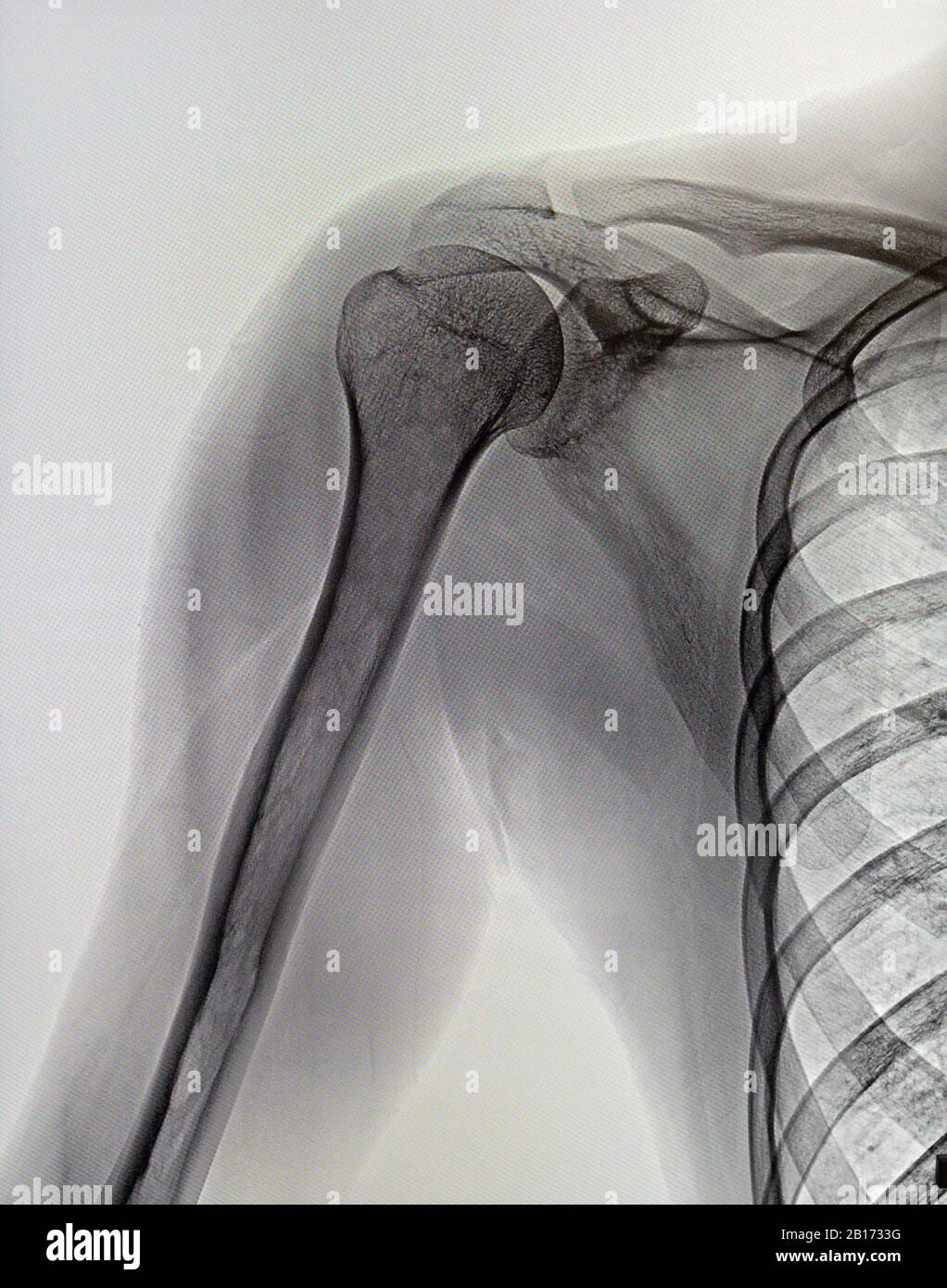 X-rays image of the painful or injury shoulder joint, shoulder dislocation. Medicine Stock Photo