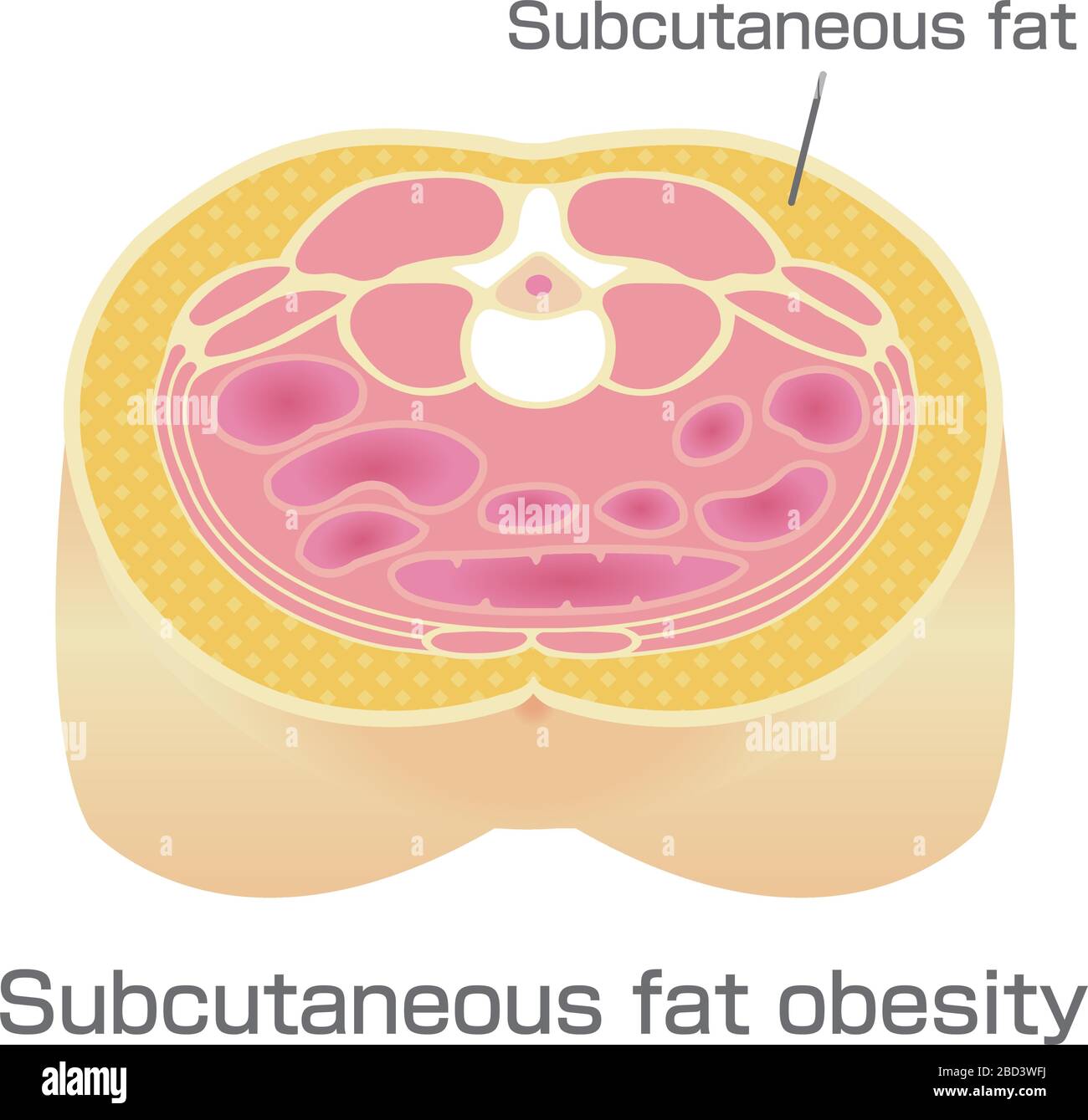 Illustration Of Different Types Of Obesity Abdominal - vrogue.co