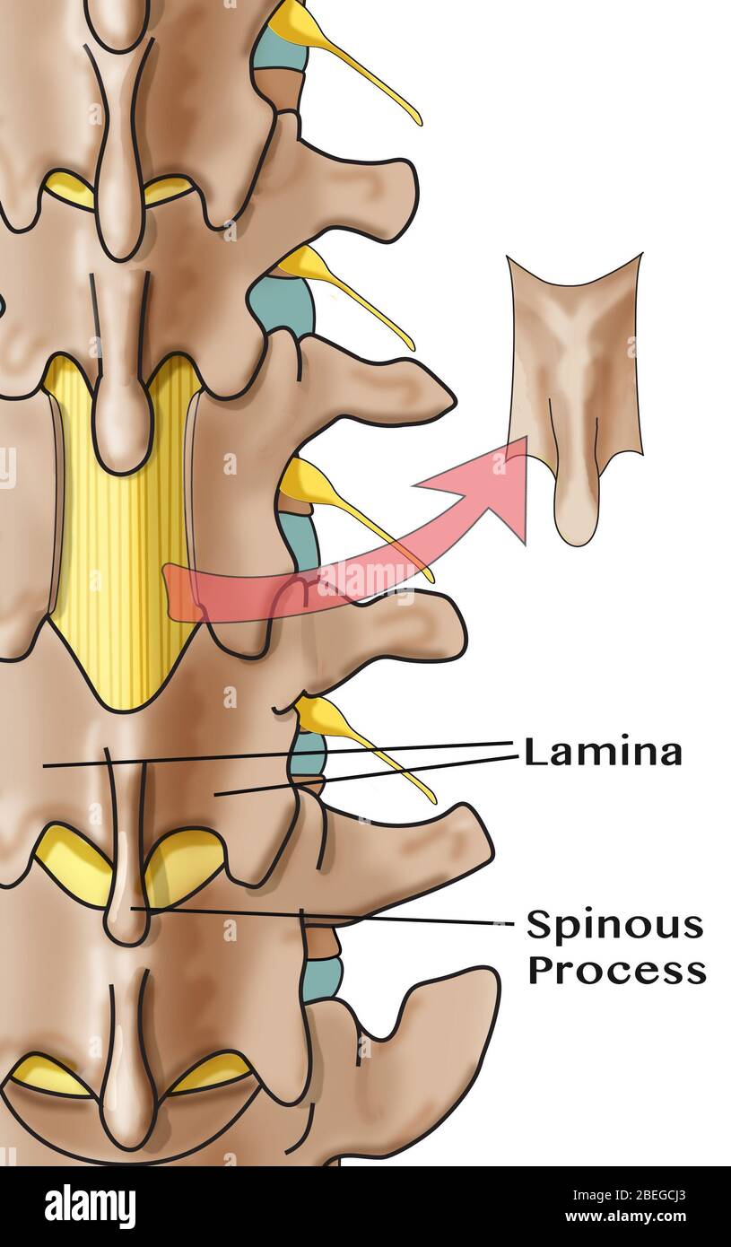 Laminectomy, Illustration Stock Photo