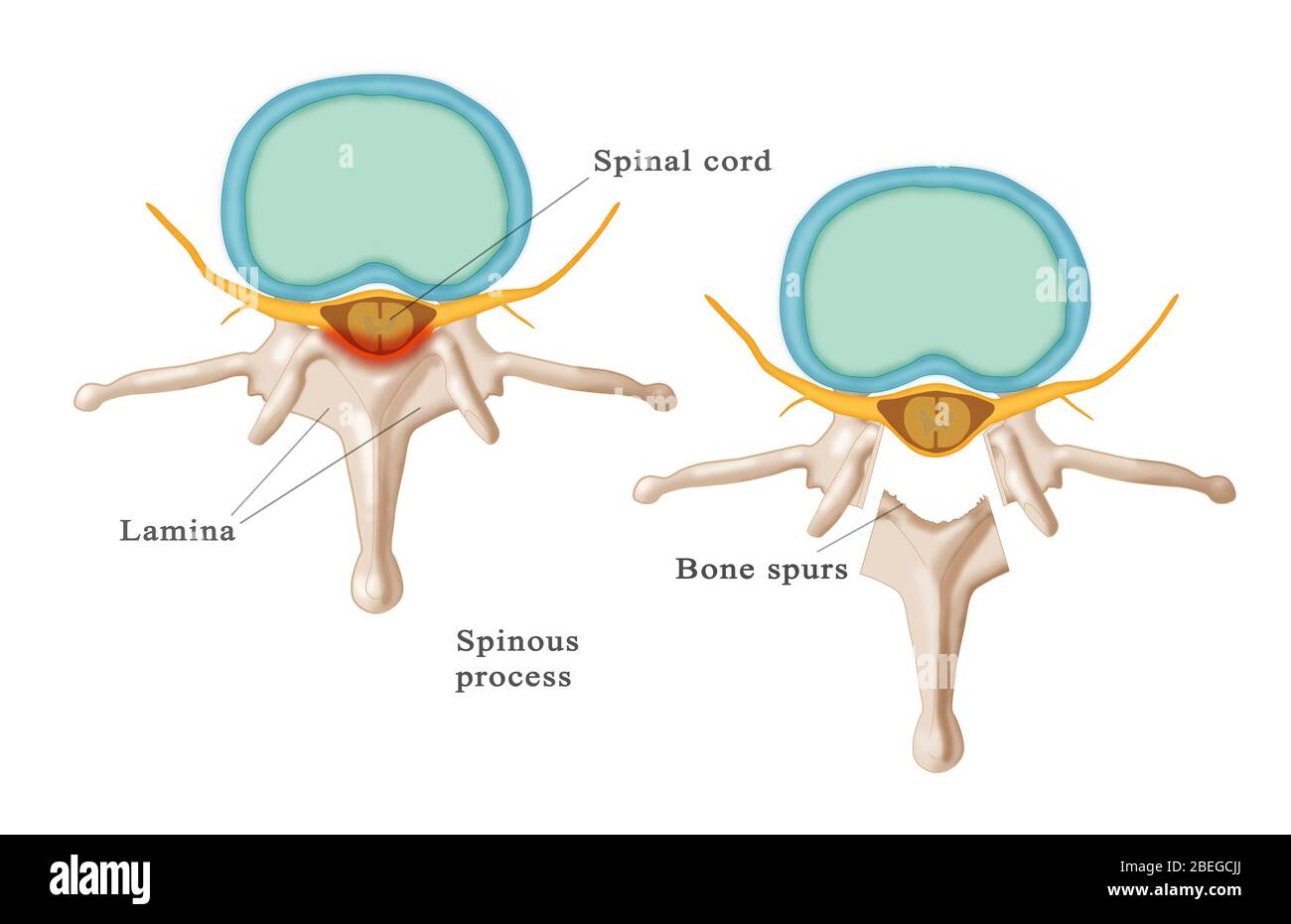 A laminectomy due to bone spurs. This medical procedure relieves pressure on the spinal cord. Stock Photo