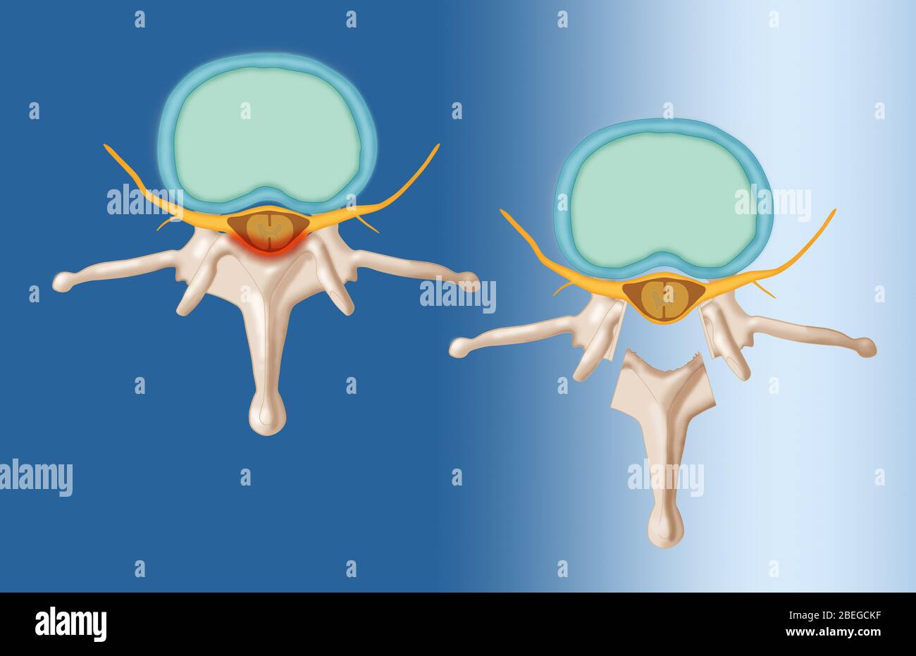 Laminectomy, Illustration Stock Photo