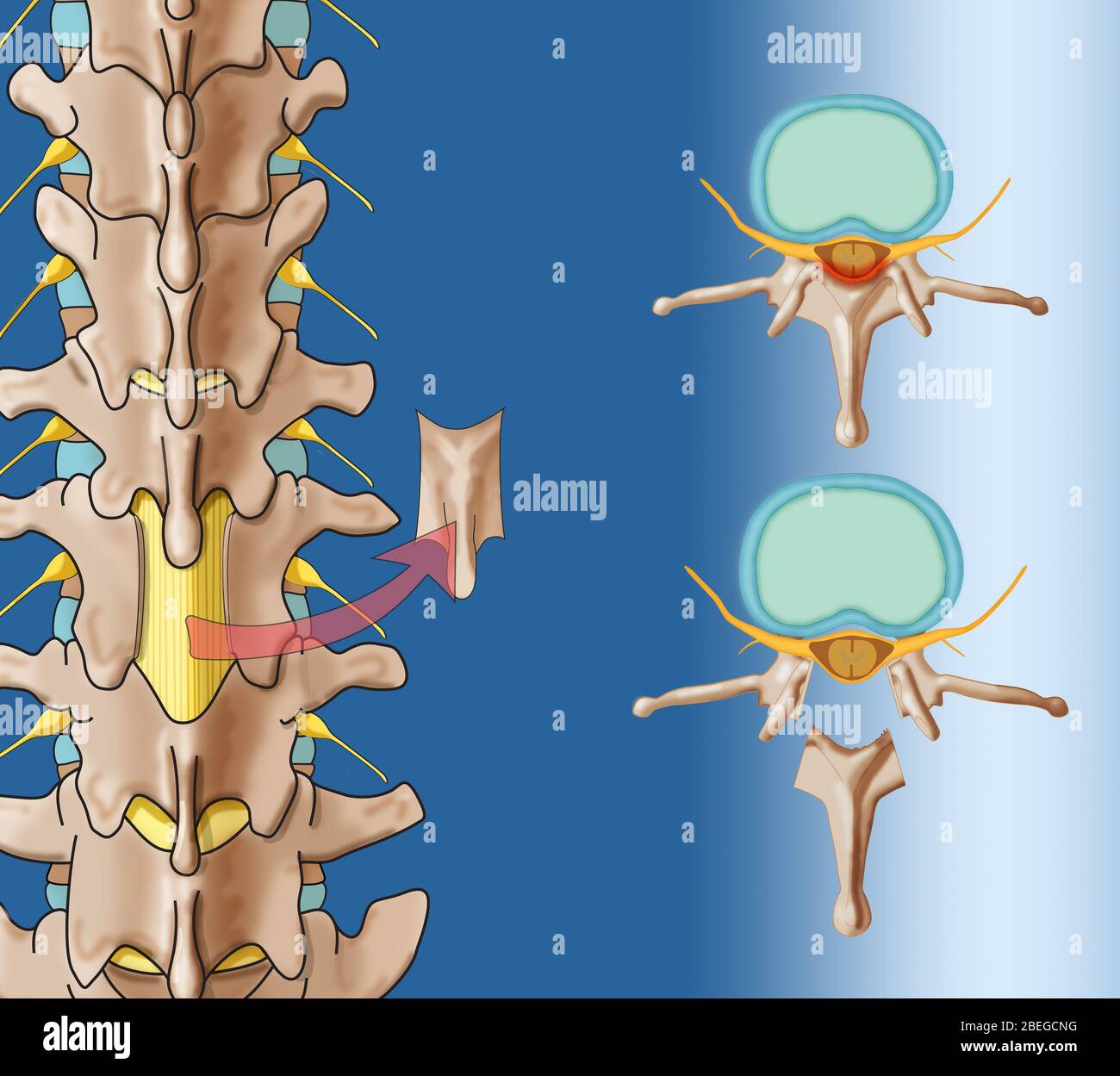 Laminectomy, Illustration Stock Photo