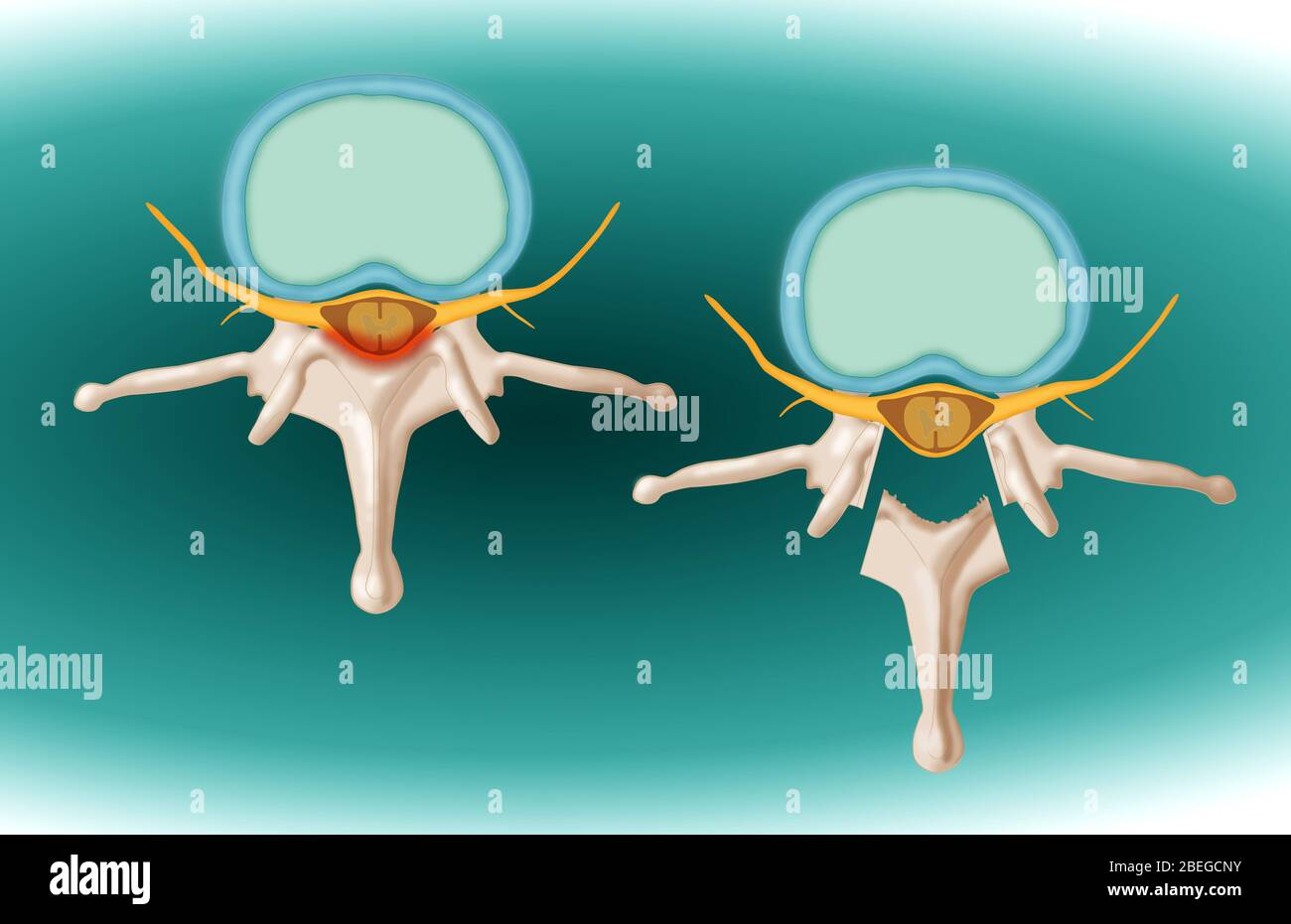 A laminectomy due to bone spurs. This medical procedure relieves pressure on the spinal cord. Stock Photo