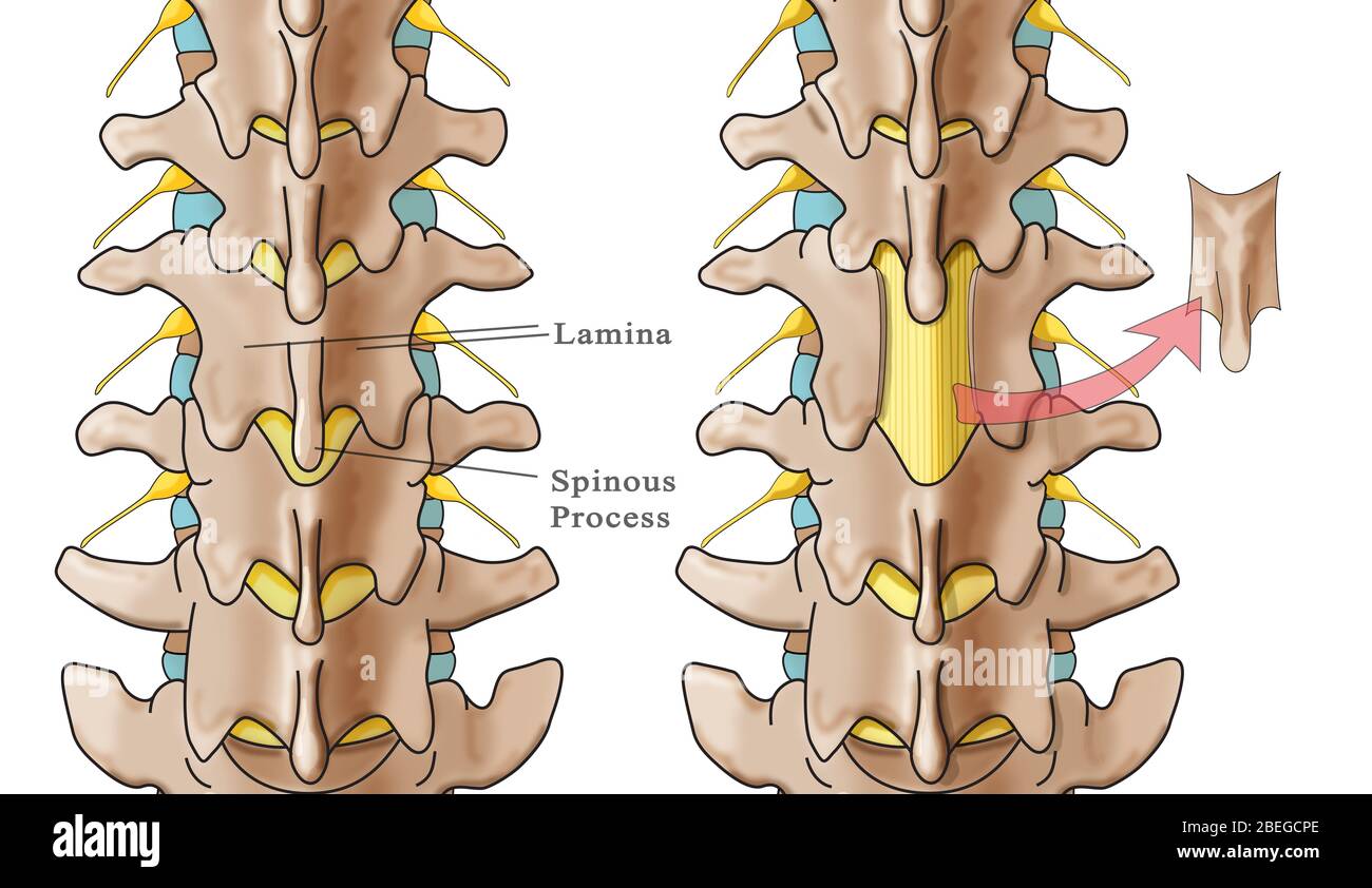 Laminectomy, Illustration Stock Photo