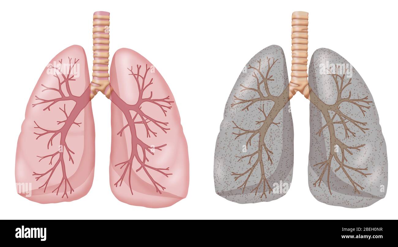 Non Smoker Lungs Vs Smoker