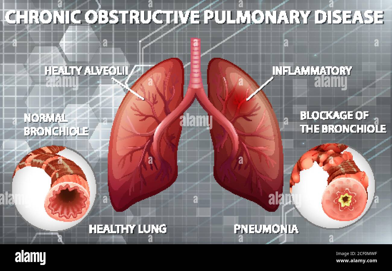 How Does Chronic Obstructive Pulmonary Disease Affect Lung Capacity ...