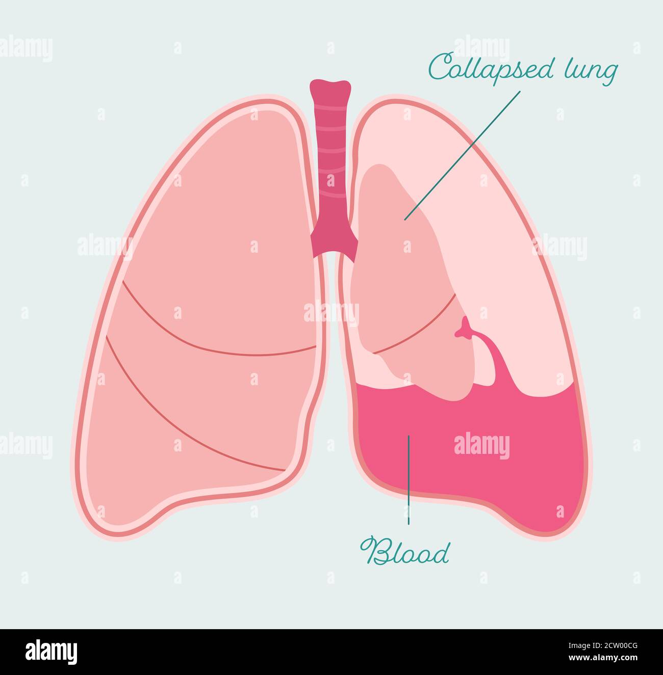 Picture Pneumothorax Hemothorax