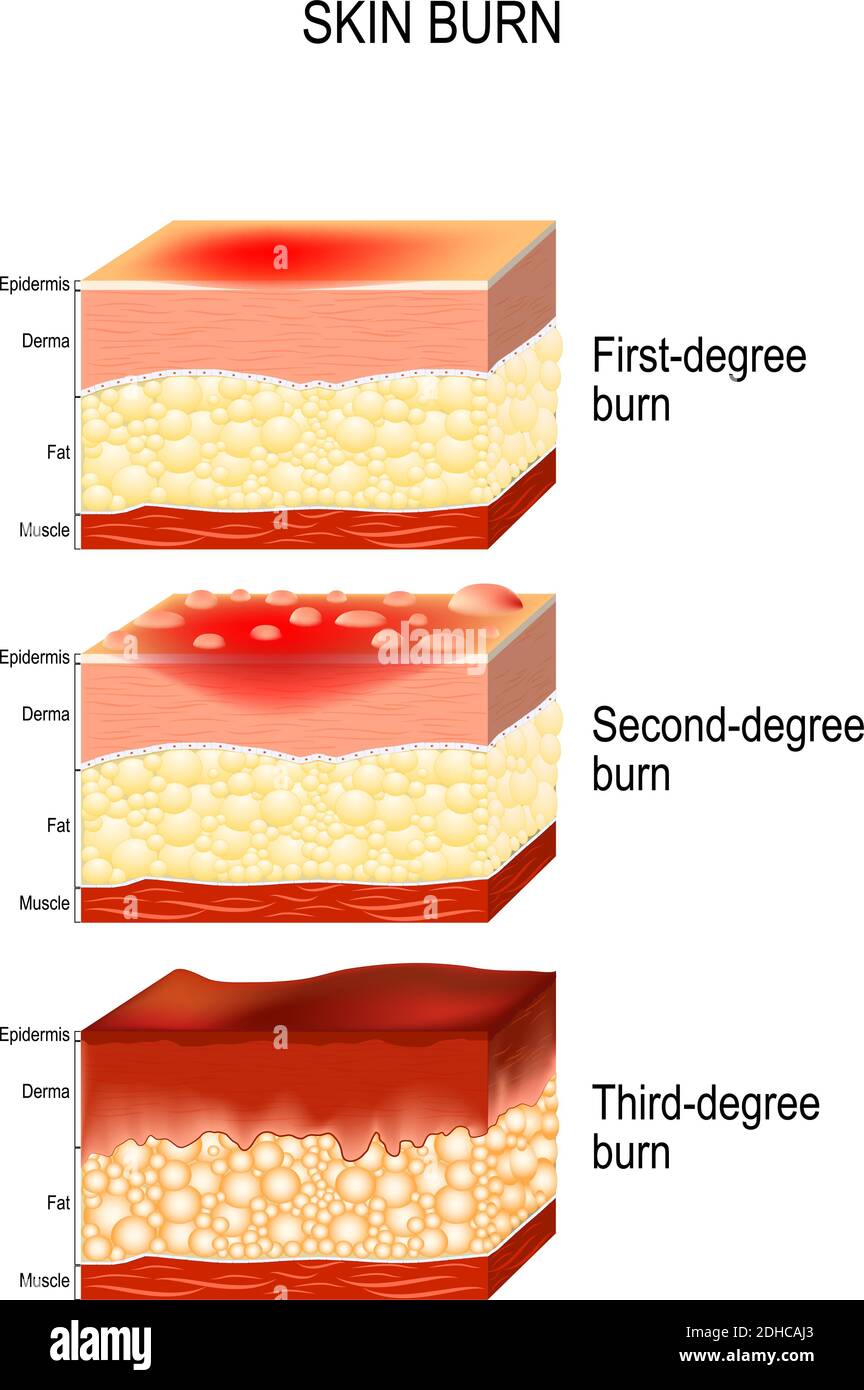 Burned Skin First Degree