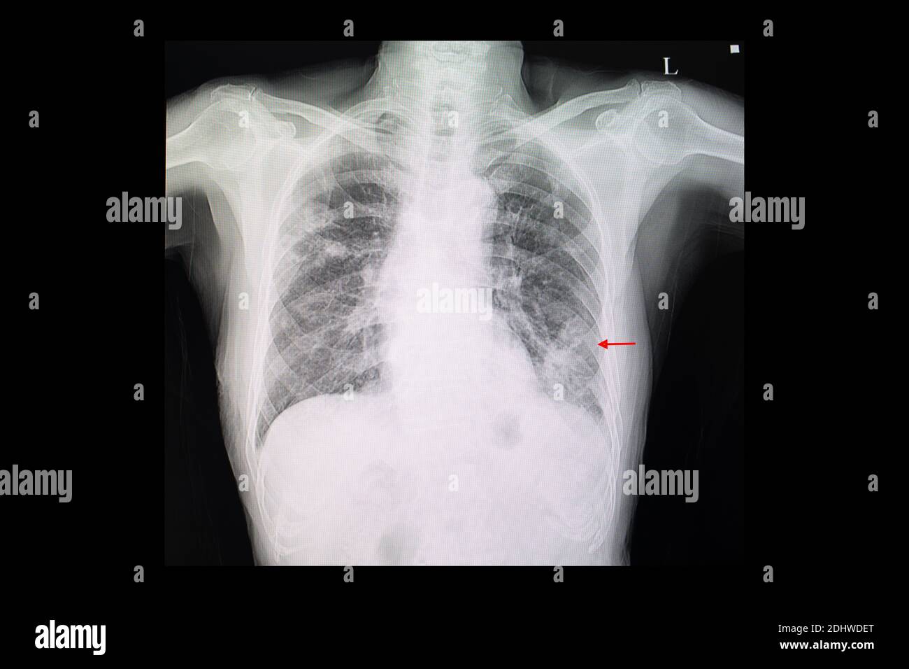 Left Upper Lung Pneumonia