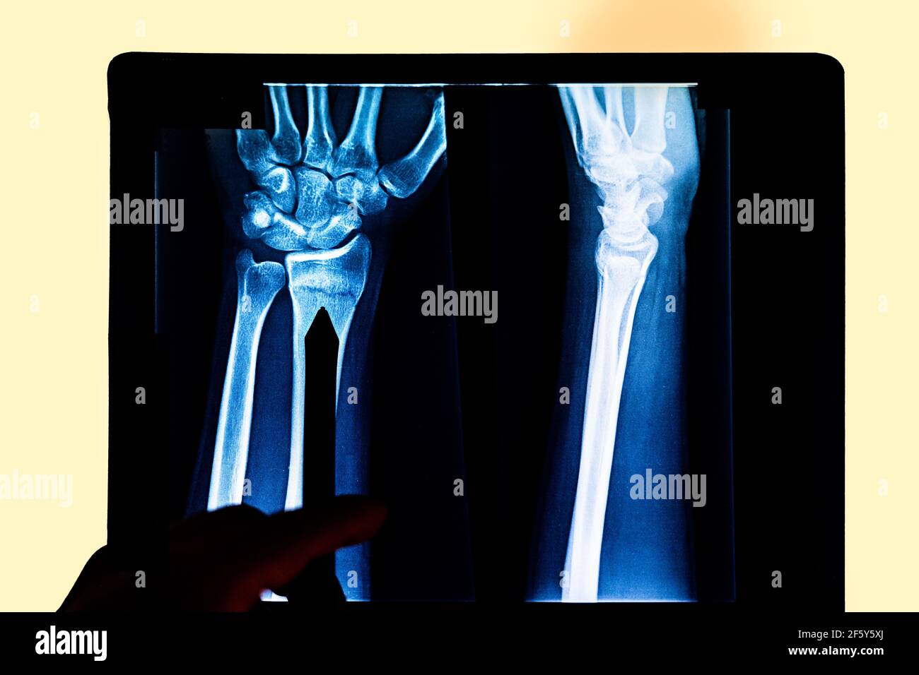 Person pointing an X-ray of arm and hand in the dark. Medical concept Stock Photo