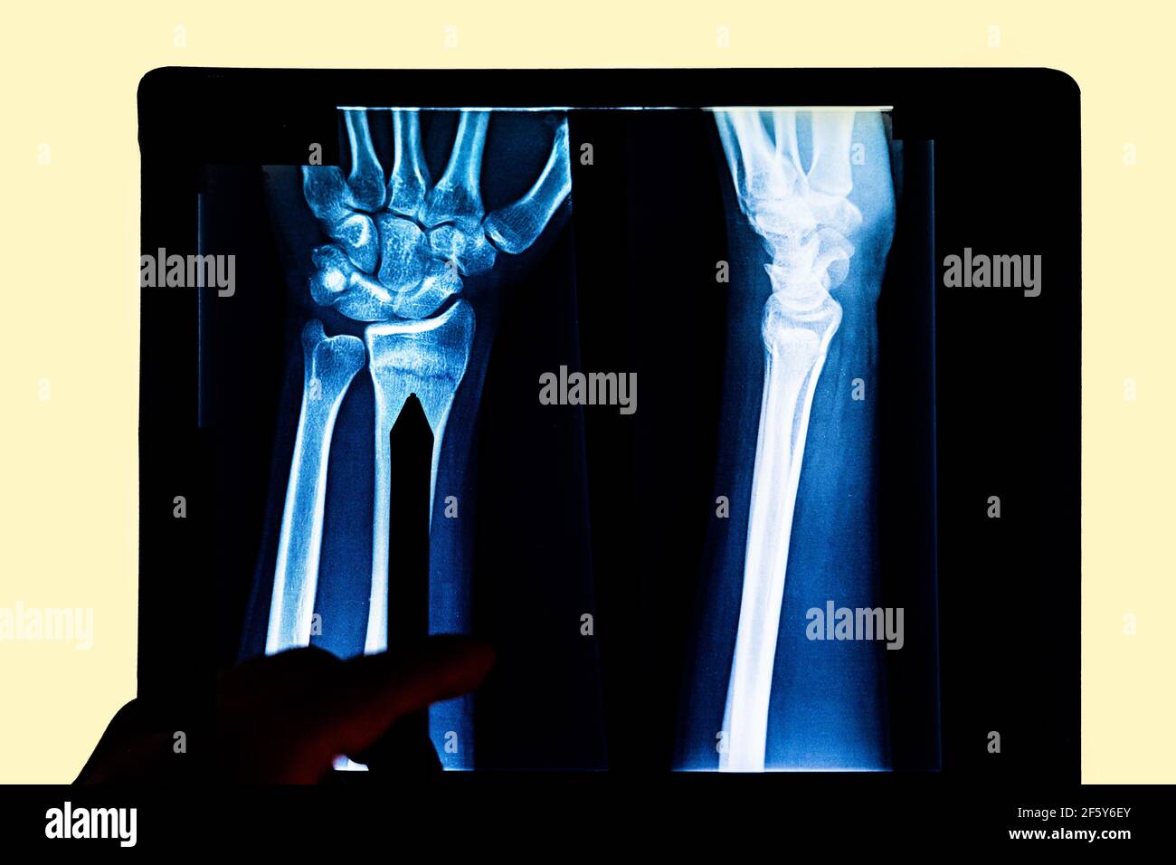 Person pointing an X-ray of arm and hand in the dark. Medical concept Stock Photo