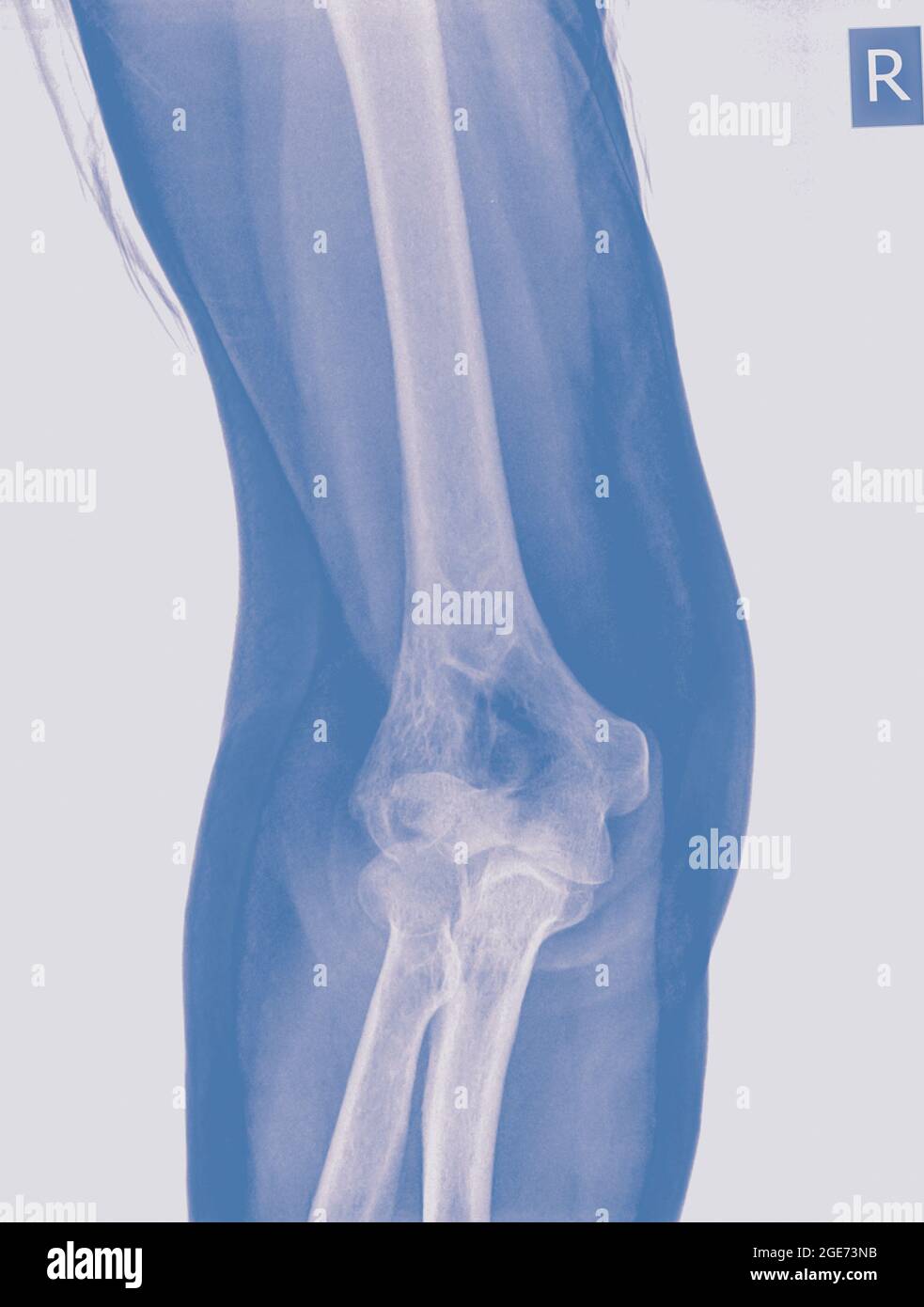 X ray of a fractured elbow (Humerus bone) of a 70 year old female patient Front view Stock Photo