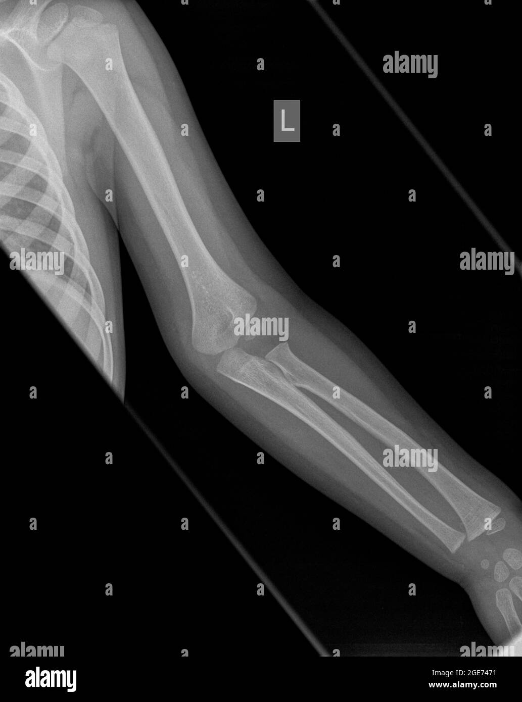 X-ray of a Human forearm with fat pad signs and a Supracondylar humerus fracture on the left arm of a 3 year old male infant Stock Photo